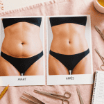 diastasis avant apres photo abdomen femme